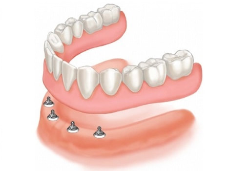 Dentures in El Paso, TX