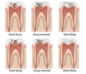 Tooth Fillings El Paso, TX