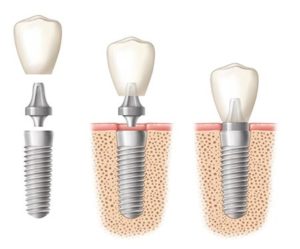 Dental Implants in El Paso, TX