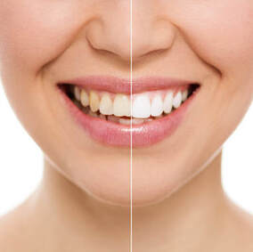 Teeth Whitening El Paso, TX