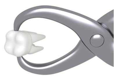 Tooth Extraction - El Paso, TX