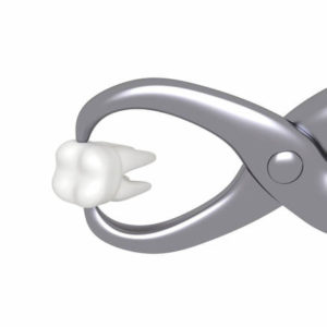 Tooth Extractions in El Paso, TX