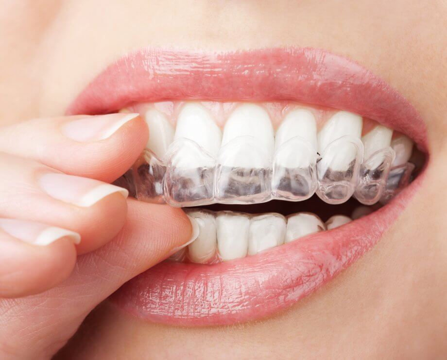 Invisalign in El Paso, TX