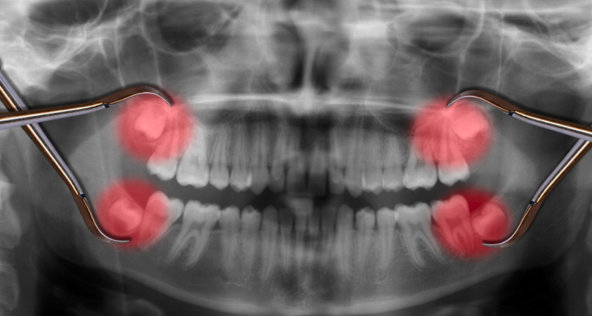 Wisdom Tooth Extraction El Paso