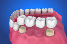 Dental Crowns & Bridges in El Paso, TX - Affordable Pricing & Financial Options.