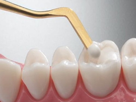 Cavity Fillings in East El Paso, TX