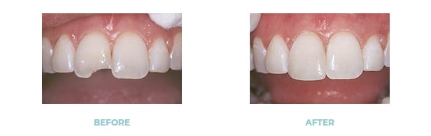 Dental Bonding El Paso, TX