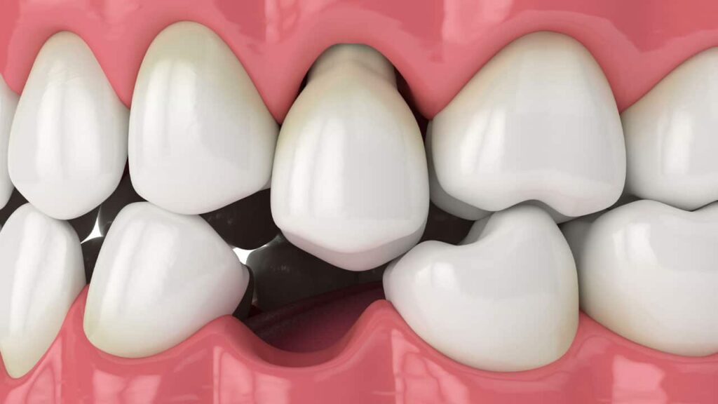 Missing Teeth - Tooth Extraction - Tooth Replacement | The Dentist El Paso