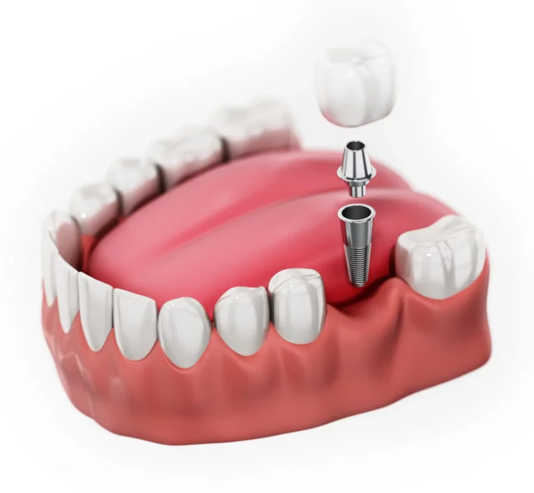 A Comprehensive Guide to Post-Operative Dental Implant Care