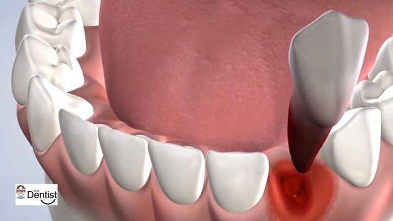 Comprehensive Post-Operative Care Guide for Tooth Extractions
