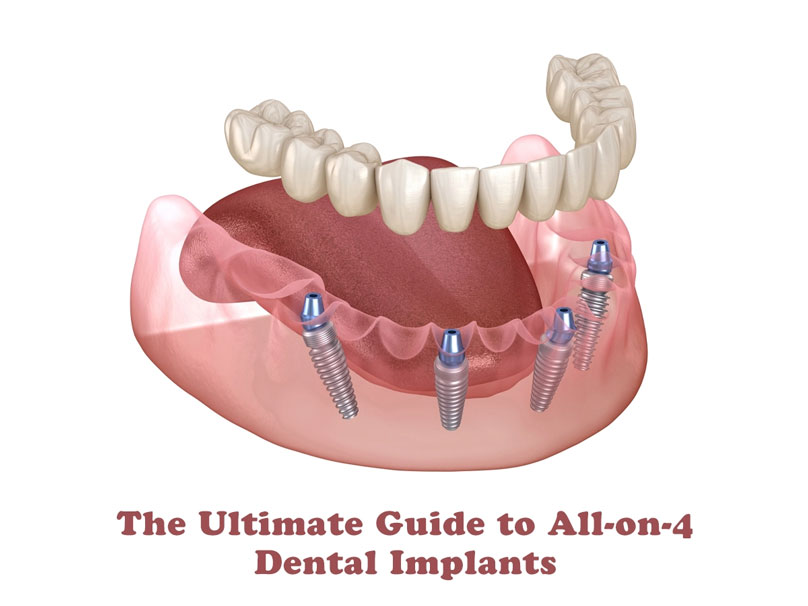 All-On-4 Dental Implants -The Dentist El Paso - All-On-Four implants are ideal for patients who have significant tooth loss or want a permanent alternative to dentures.