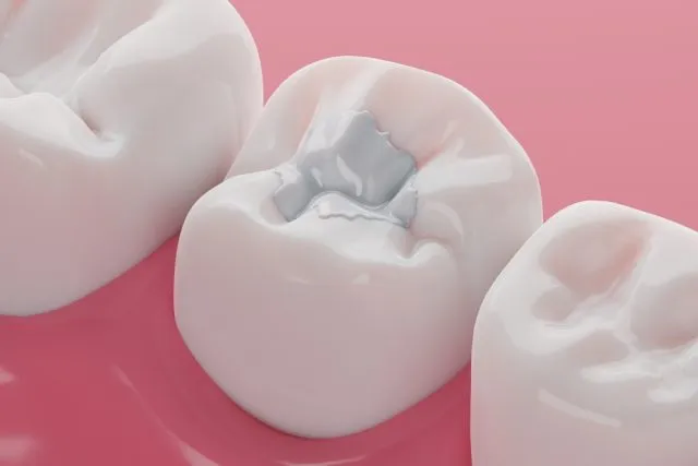A Patient Guide to Composite Filling Aftercare